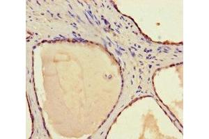 Immunohistochemistry of paraffin-embedded human prostate cancer using ABIN7170686 at dilution of 1:100
