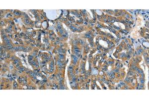 Immunohistochemistry of paraffin-embedded Human thyroid cancer tissue using ADCY4 Polyclonal Antibody at dilution 1:45 (ADCY4 anticorps)