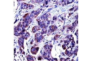 Caspase-6 antibody immunohistochemistry analysis in formalin fixed and paraffin embedded human bladder carcinoma. (Caspase 6 anticorps  (AA 17-45))