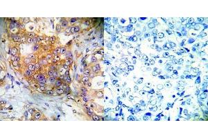 Immunohistochemical analysis of paraffin- embedded human breast carcinoma tissue using 4E-BP1 (Ab-65) antibody (E022001). (eIF4EBP1 anticorps)