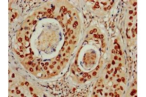 IHC image of ABIN7150328 diluted at 1:600 and staining in paraffin-embedded human cervical cancer performed on a Leica BondTM system.