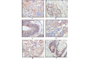 Immunohistochemical analysis of paraffin-embedded human lung squamous cell carcinoma (A), lung adenocarcinoma (B), colon carcinoma (C), breast carcinoma (D), normal sublingual gland (E), normal rectal (F), showing membrane localization with DAB staining using EphB3 antibody. (EPH Receptor B3 anticorps  (AA 39-212))
