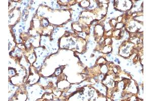 Formalin-fixed, paraffin-embedded human Angiosarcoma stained with CD34 Monoclonal Antibody (HPCA1/1171)