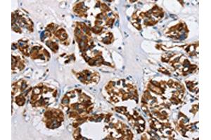 IHC analysis of paraffin-embedded human thyroid cancer tissue, using HINT2 antibody (1/50 dilution, 200X magnification). (HINT2 anticorps)