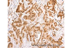 Immunohistochemistry of Human esophagus cancer using TAX1BP1 Polyclonal Antibody at dilution of 1:60 (TAX1BP1 anticorps)