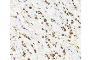 Immunohistochemistry of paraffin-embedded Human breast cancer using RAD50 Polyclonal Antibody at dilution of 1:100 (40x lens). (RAD50 anticorps)