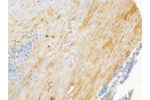 ABIN6256097 and ABIN6267261 at 1/100 staining human prostate carcinoma by IHC-P.