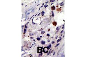 Formalin-fixed and paraffin-embedded human cancer tissue reacted with PSMD4 polyclonal antibody  , which was peroxidase-conjugated to the secondary antibody, followed by AEC staining. (PSMD4/ASF anticorps  (AA 300-328))
