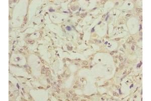 Immunohistochemistry of paraffin-embedded human pancreatic cancer using ABIN7158058 at dilution of 1:100 (LRTM1 anticorps  (AA 1-212))