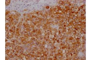 IHC image of ABIN7180656 diluted at 1:100 and staining in paraffin-embedded human colon cancer performed on a Leica BondTM system.