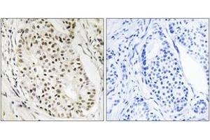Immunohistochemistry analysis of paraffin-embedded human breast carcinoma tissue, using HNRNPUL2 Antibody. (HNRNPUL2 anticorps  (AA 601-650))