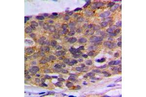 Immunohistochemical analysis of PLA2G4A staining in human breast cancer formalin fixed paraffin embedded tissue section. (PLA2G4A anticorps  (Center))