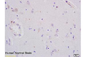 Formalin-fixed and paraffin embedded human glioma tissue labeled with Anti-PCNA Polyclonal Antibody, Unconjugated (ABIN676583) at 1:200 followed by conjugation to the secondary antibody and DAB staining (PCNA anticorps  (AA 151-261))