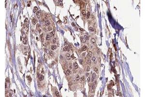 ABIN6272333 at 1/100 staining Human breast cancer tissue by IHC-P. (KIF13B anticorps  (C-Term))