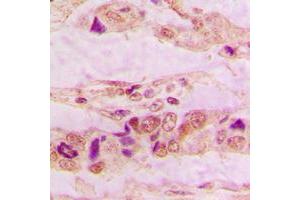 Immunohistochemical analysis of Annexin A3 staining in human lung cancer formalin fixed paraffin embedded tissue section.