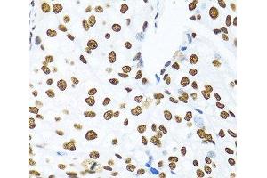 Immunohistochemistry of paraffin-embedded Human prostate cancer using KHDRBS1 Polyclonal Antibody at dilution of 1:100 (40x lens).