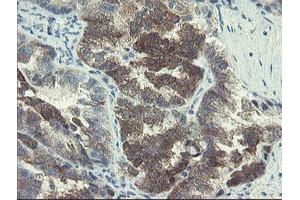 Immunohistochemical staining of paraffin-embedded Adenocarcinoma of Human ovary tissue using anti-DOK7 mouse monoclonal antibody. (DOK7 anticorps)