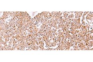 Immunohistochemistry of paraffin-embedded Human ovarian cancer tissue using IRX2 Polyclonal Antibody at dilution of 1:45(x200) (IRX2 anticorps)