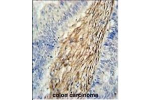 C3orf75 Antibody (C-term) (ABIN651356 and ABIN2840198) immunohistochemistry analysis in formalin fixed and paraffin embedded human colon carcinoma followed by peroxidase conjugation of the secondary antibody and DAB staining.
