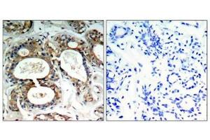 Immunohistochemical analysis of paraffin-embedded human breast carcinoma tissue using SHP-2(Phospho-Tyr542) Antibody(left) or the same antibody preincubated with blocking peptide(right).