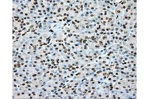Immunohistochemical staining of paraffin-embedded Adenocarcinoma of colon tissue using anti-CYP1A2 mouse monoclonal antibody. (CYP1A2 anticorps)