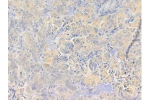 ABIN6257755 and ABIN6273649 at 1/100 staining human lung adenocarcinoma by IHC-P. (IL12B anticorps  (C-Term))