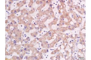Formalin-fixed and paraffin embedded human lung carcinoma labeled with Rabbit Anti-AP1M2 Polyclonal Antibody, Unconjugated  at 1:200 followed by conjugation to the secondary antibody and DAB staining (AP1m2 anticorps  (AA 1-100))