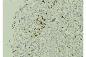 ABIN6272880 at 1/100 staining Human breast cancer tissue by IHC-P.