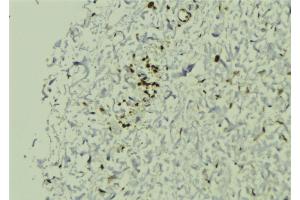 ABIN6272880 at 1/100 staining Human breast cancer tissue by IHC-P. (SGTA anticorps  (C-Term))