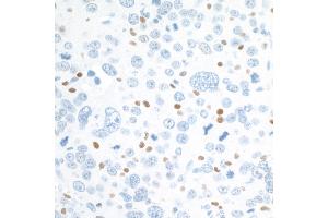 Immunohistochemistry (IHC) image for anti-V-Maf Musculoaponeurotic Fibrosarcoma Oncogene Homolog (Avian) (MAF) (AA 125-175) antibody (ABIN7455089) (Recombinant MAF anticorps  (AA 125-175))