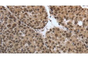 Immunohistochemistry of paraffin-embedded Human liver cancer tissue using SMAD7 Polyclonal Antibody at dilution 1:40 (SMAD7 anticorps)