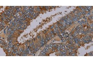 Immunohistochemistry of paraffin-embedded Human colon cancer tissue using PYY Polyclonal Antibody at dilution 1:30 (Peptide YY anticorps)