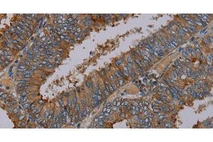 Immunohistochemistry of paraffin-embedded Human colon cancer tissue using PYY Polyclonal Antibody at dilution 1:30