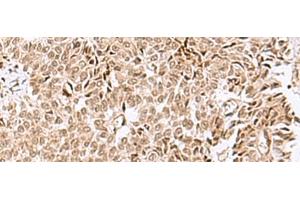 Immunohistochemistry of paraffin-embedded Human ovarian cancer tissue using ELAC1 Polyclonal Antibody at dilution of 1:50(x200) (ELAC1 anticorps)