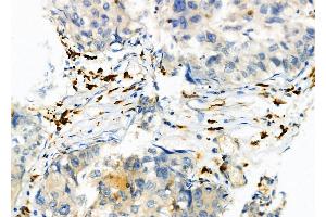 ABIN6264593 and ABIN6274042 at 1/100 staining Human pancreatic cancer by IHC-P. (RAB9A anticorps  (Internal Region))