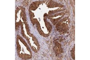 Immunohistochemical staining of human prostate with ALDH1A3 polyclonal antibody  shows strong cytoplasmic positivity in glandular cells at 1:20-1:50 dilution. (ALDH1A3 anticorps)
