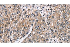 Immunohistochemistry of paraffin-embedded Human lung cancer using PPP1CC Polyclonal Antibody at dilution of 1:40