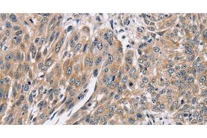 Immunohistochemistry of paraffin-embedded Human lung cancer using PPP1CC Polyclonal Antibody at dilution of 1:40 (PPP1CC anticorps)