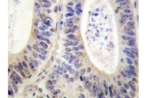 Immunohistochemistry analyzes of p47-phox antibody in paraffin-embedded human colon carcinoma tissue. (NCF1 anticorps)