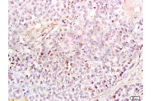 Formalin-fixed and paraffin embedded human endometrium carcinoma labeled Anti-HMGB1 Polyclonal Antibody, Unconjugated  at 1:200, followed by conjugation to the secondary antibody and DAB staining (HMGB1 anticorps  (AA 75-170))