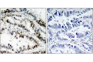 Immunohistochemistry analysis of paraffin-embedded human lung carcinoma, using SMC1 (Phospho-Ser957) Antibody. (SMC1A anticorps  (pSer957))
