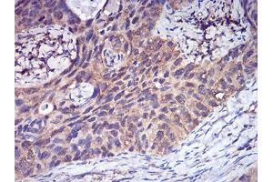 Immunohistochemical analysis of paraffin-embedded cervical cancer tissues using CFHR5 mouse mAb with DAB staining.
