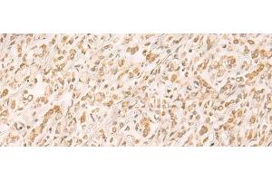 Immunohistochemistry of paraffin-embedded Human gastric cancer tissue using SETD1A Polyclonal Antibody at dilution of 1:25(x200) (SETD1A anticorps)
