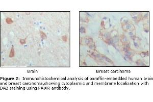 Immunohistochemical analysis of paraffin-embedded human brain (left) and breast carcinoma (right), showing cytoplasmic and membrane localization using PAR4 mouse mAb with DAB staining. (F2RL3 anticorps  (AA 1-330))