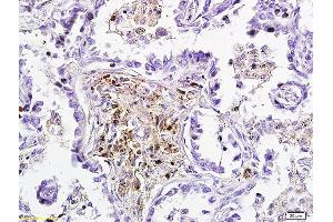 Formalin-fixed and paraffin embedded human lung carcinoma labeled with Anti-DKK3 Polyclonal Antibody, Unconjugated (ABIN749123) followed by conjugation to the secondary antibody and DAB staining (DKK3 anticorps  (AA 31-130))