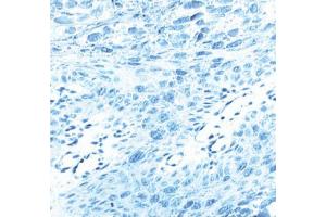 Immunohistochemical staining for human papilloma virus (HPV) type 16, L1 protein.