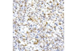 Immunohistochemistry of paraffin-embedded Undifferentiated carcinoma of human esophagus using SM/SNF5 Rabbit pAb  at dilution of 1:250 (40x lens).