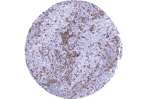 Uterus cervix TIM3 negative squamous cell carcinoma showing a large number of TIM3 positive macrophages and also lymphocytes