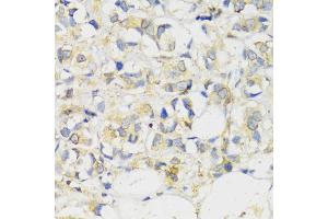 Immunohistochemistry of paraffin-embedded human breast cancer using MLKL antibody (ABIN6134395, ABIN6143882, ABIN6143886 and ABIN6217454) at dilution of 1:100 (40x lens). (MLKL anticorps  (C-Term))