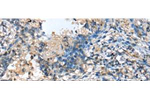 Immunohistochemistry of paraffin-embedded Human lung cancer tissue using MOB4 Polyclonal Antibody at dilution of 1:25(x200) (MOBKL3 anticorps)